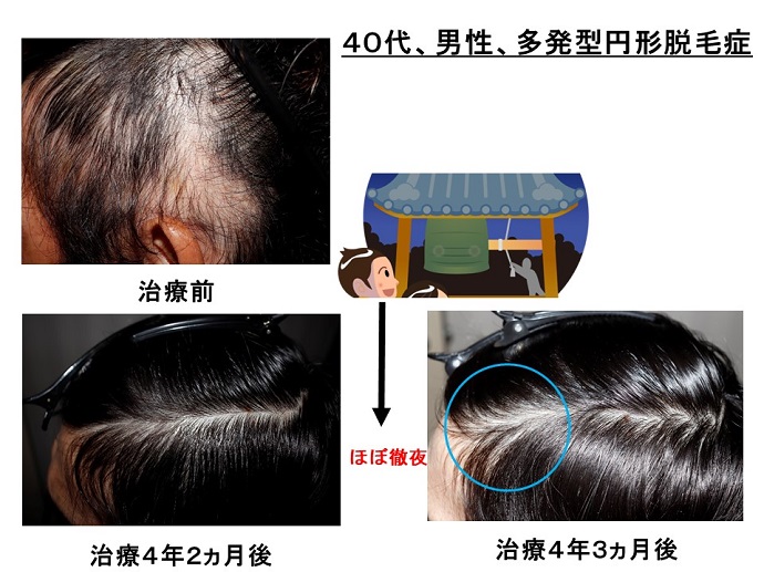 円形脱毛症　病院